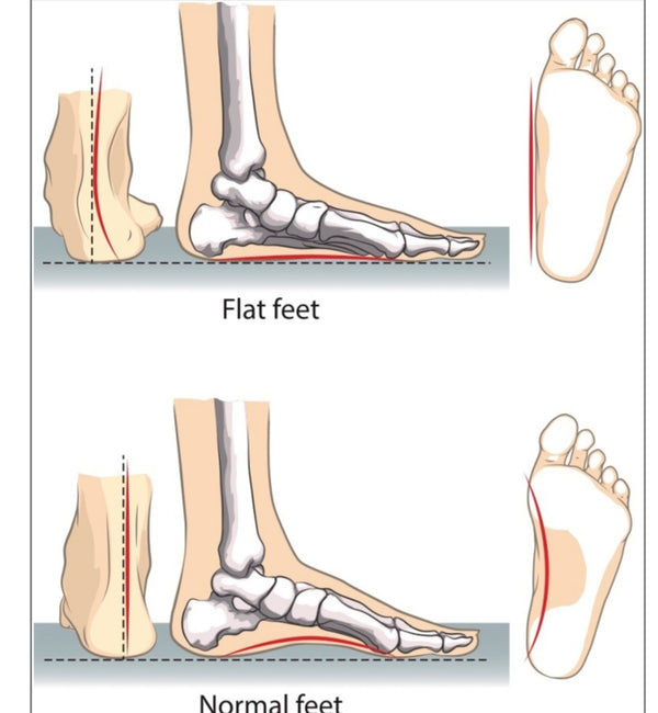 What are Flat Feet - Causes, Treatment & Diagnosis by CMM