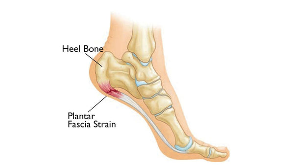 How To Deal with the Heel Three Types of Common Heel Pain? - CMM - Your Foot Doctor