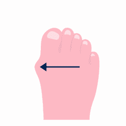 10 Step Guide for Treating Bunion Pain - CMM - Your Foot Doctor