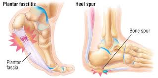 Orthopedic Footwear for Heel Spur & Plantar Fasciitis by Colour Me Mad (CMM)